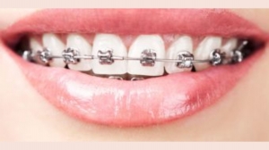 Cracked or Chipped: How Front Tooth Crowns Come to the Rescue